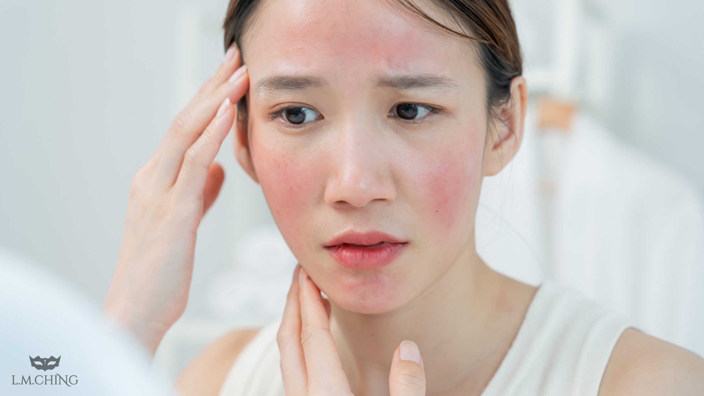 Stinging, Rosacea, and Climate Stress