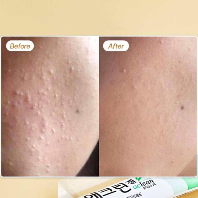 DONG-A PHARM Aclean Gel 20 g