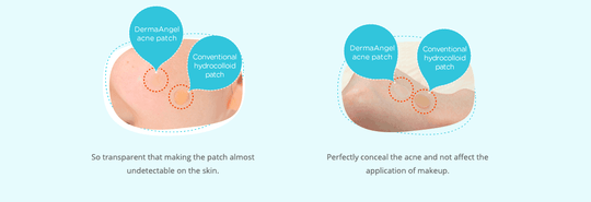 DermaAngel Taiwan Acne Pimple Ultra Thinness Healing Patch (For Day) 18pcs - LMCHING Group Limited