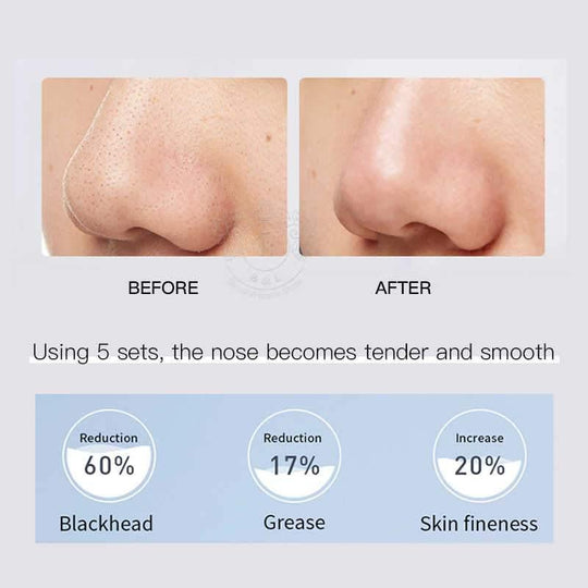 EIIO Anti-Pore Blackhead Kit 1 box/10pcs - LMCHING Group Limited