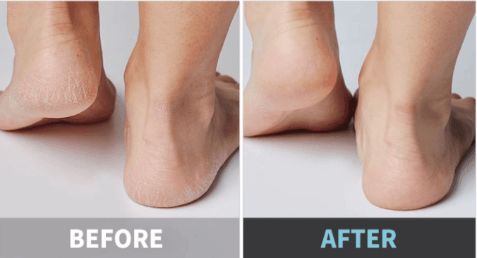 plu Intensive Repair Foot Cream + Foot Peeling Machine (2 Items) - LMCHING Group Limited
